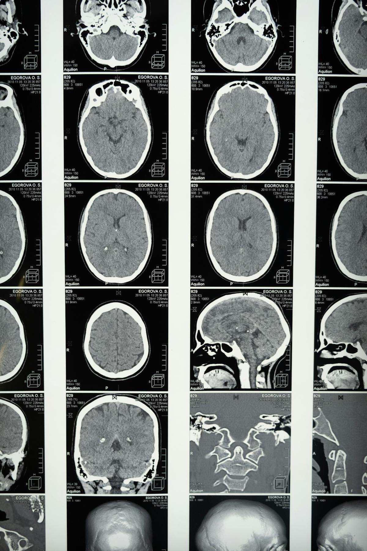 Depo-Provera and Brain Tumors: What the Latest Research Shows